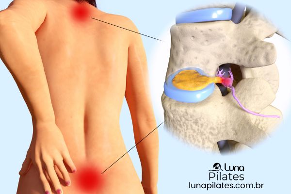 Pilates para Hérnia de Disco